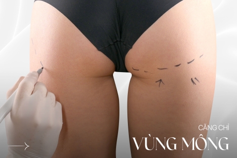 Căng chỉ vùng mông
